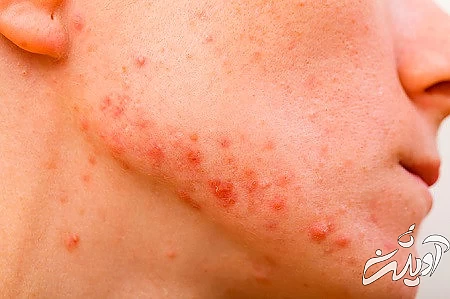 خشکی پوست ناشی از کمبودهای تغذیه ای ,آکنه صورت